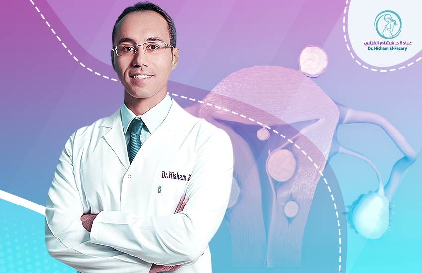 كيف أختار أفضل دكتور لعلاج الأورام الليفية؟