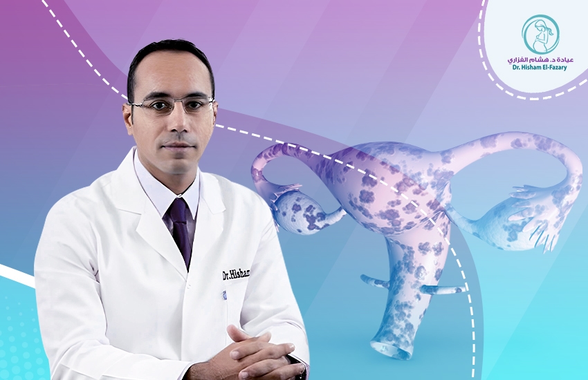 أفضل دكتور لعلاج بطانة الرحم المهاجرة أفضل دكتور لعلاج بطانة الرحم المهاجرة