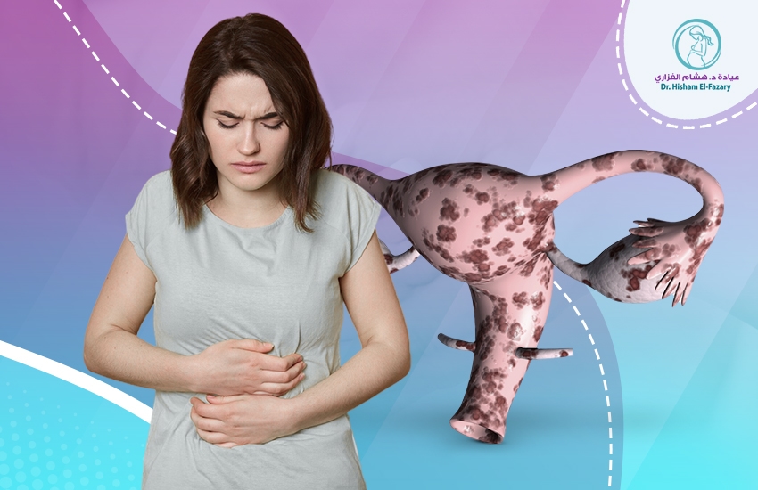 اعراض-بطانة-الرحم-المهاجرة أعراض بطانة الرحم المهاجرة وكيفية تشخيصها