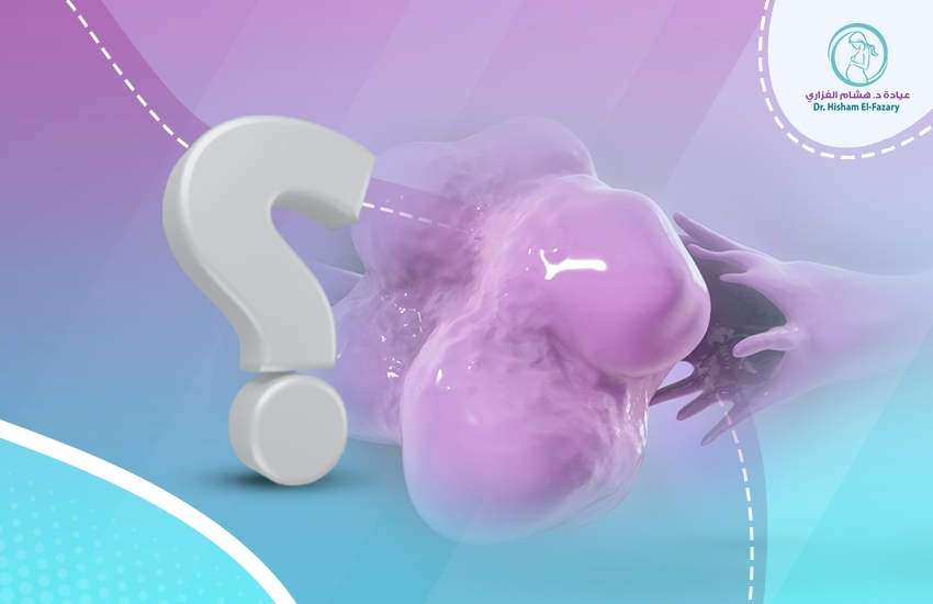 ما هي أكياس المبيض وأنواعها؟