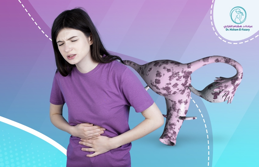 ما هي بطانة الرحم المهاجرة