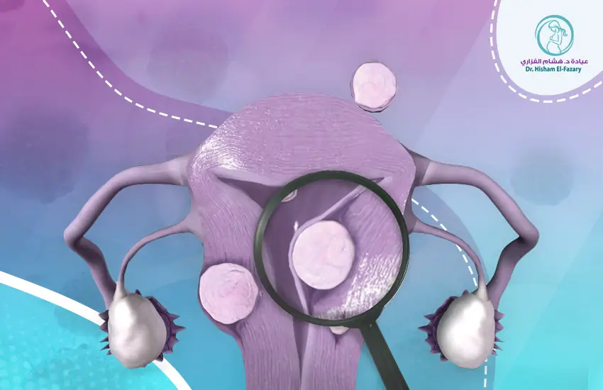 عملية-الاورام-الليفية-في-الرحم عملية الأورام الليفية في الرحم