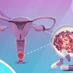 علاج التهابات المهبل