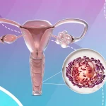 أسباب التهاب المهبل