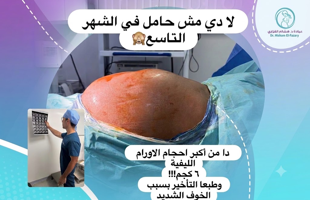 سيدة بطنها منتفخة من الاورام الليفية وتستعد لاجراء العملية مع دكتور هشام الفزاري
